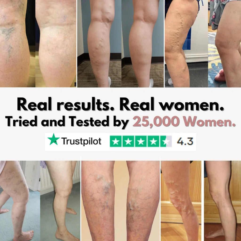 From Spider Vein & heavy legs to visible relief for healthcare workers