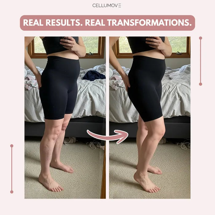 3D Legging – Post partum Edema