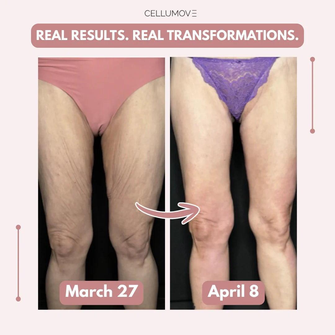 Firmer, smoother legs — for women tired of saggy skin holding them back