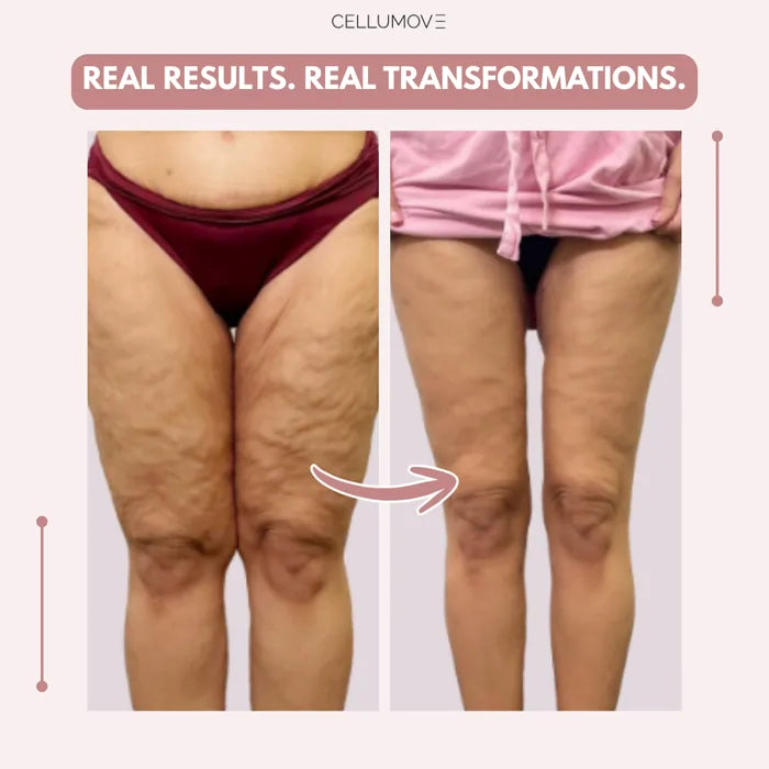 3D Legging – Say goodbye to lipoedema pain and swelling naturally